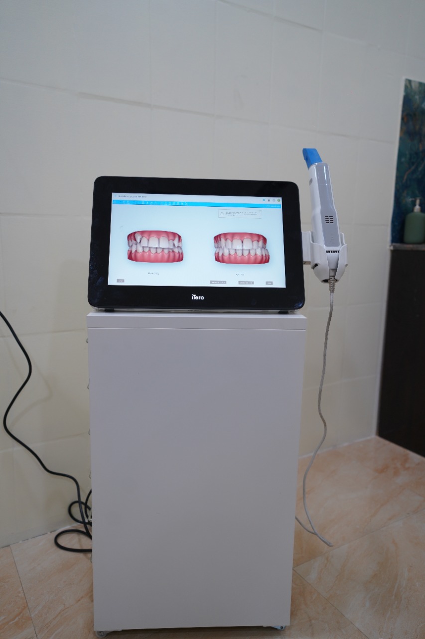iTero digital scanner β 3D impressions for Invisalign & aligners, no messy moulds